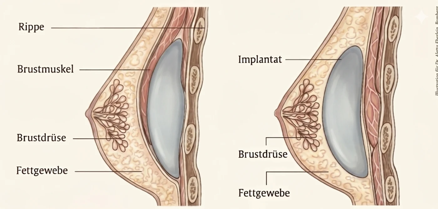 Illustration zur Lage von Brustimplantaten vor und hinter dem Brustmuskel